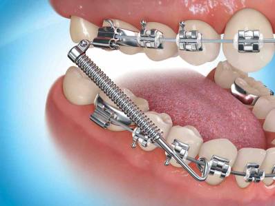 What Is Orthodontics