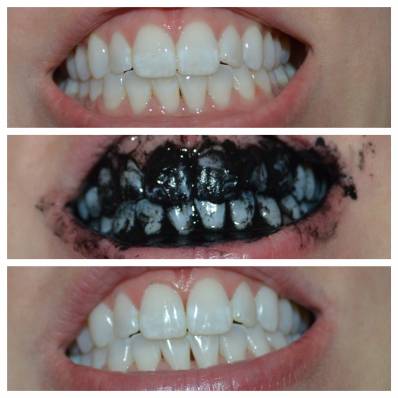 Whitening Teeth With Activated Charcoal