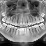 X-Rays of Teeth What You Should Know