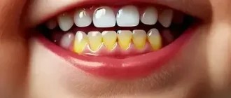 Brown Teeth in Babies