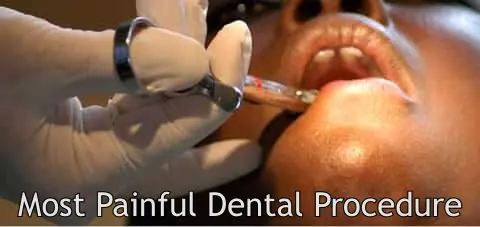 Most Painful Dental Procedure