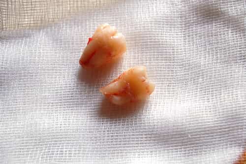 removed wisdom teeth