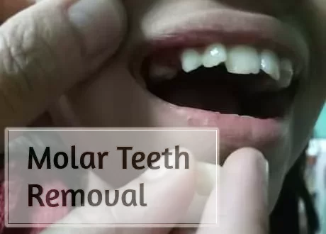 Molar Teeth Removal