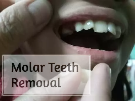 Molar Teeth Removal