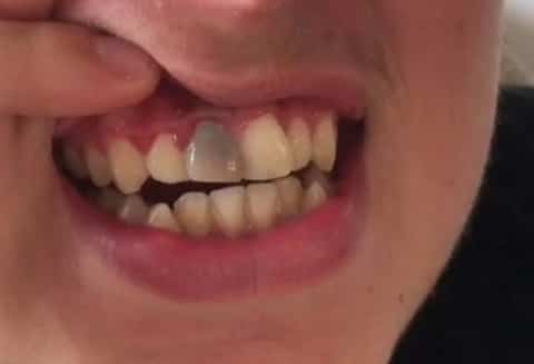 Boy shows a black tooth