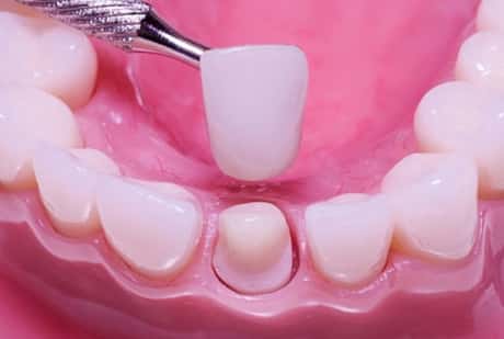 crowning dental procedure