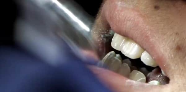 laser teeth whitening cost - preparation