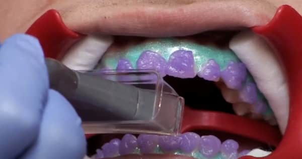 Dentist applying laser to whiten teeth