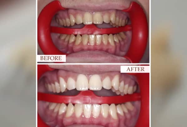 Cost of laser teeth whitening - is it worth it?