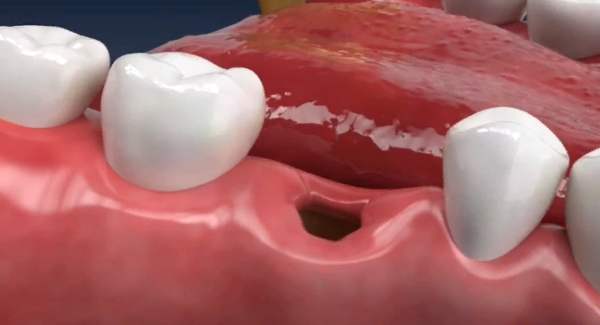 Infection after Tooth Extraction
