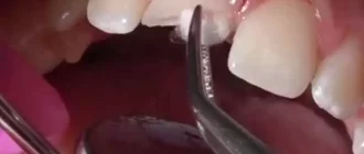 Horizontal Crack in Tooth