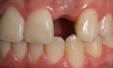 Tooth Loss