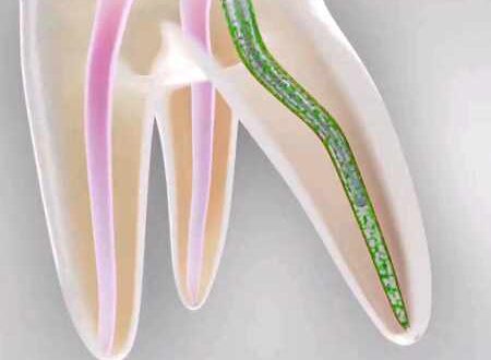 Toothache After a Root Canal Cleaning
