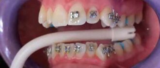 Contraindications to Wearing Braces