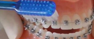 Teeth Wobbling Under Braces