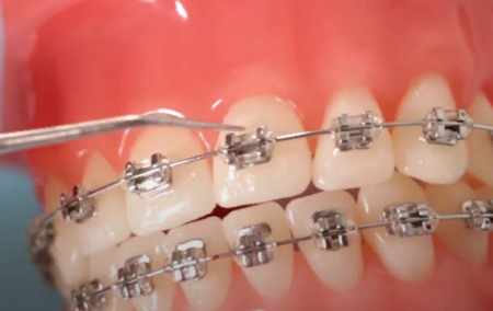 Are Braces Worth It?