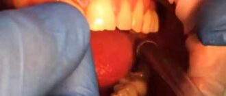 Tooth Pain Under the Crown