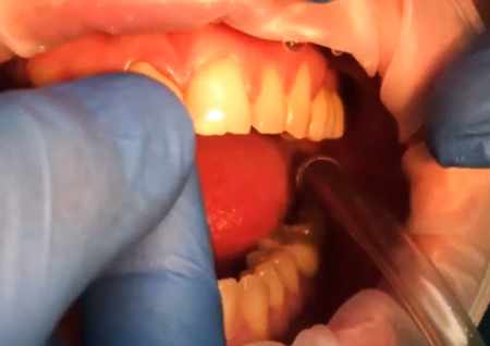 Tooth Pain Under the Crown