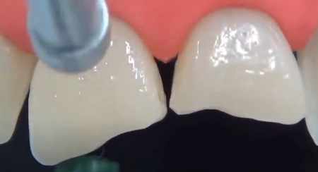 Front teeth restorations