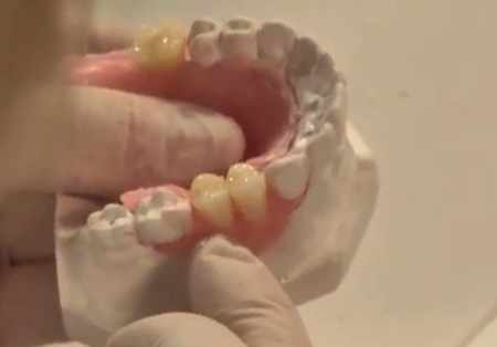 Best Dentures