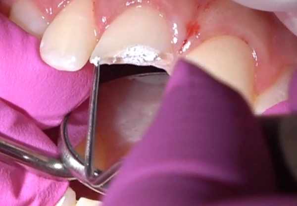 front tooth crack