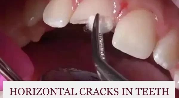 horizontal cracks in teeth