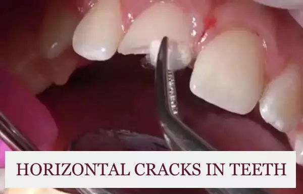 horizontal cracks in teeth