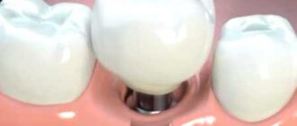 Lower Jaw Tooth Implantation