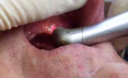 laser tooth implantation