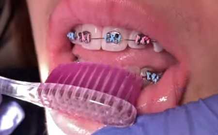 Brushing teeth with braces on with a toothbrush