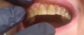 teeth darker than before