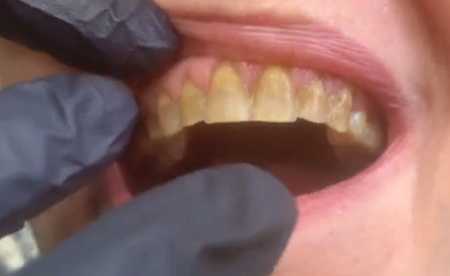 teeth darker than before