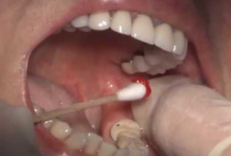 gum inflammation