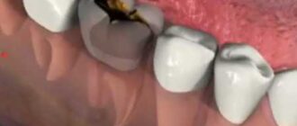 Teeth Hurt at Night