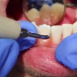 Stronger Tooth Enamel