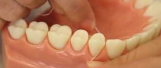 bleeding gums - what to do