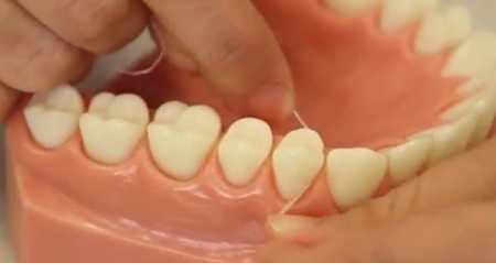 bleeding gums - what to do