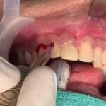 Tooth cyst removal