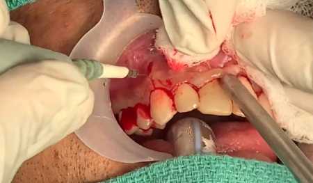 Gum surgery to remove a cyst