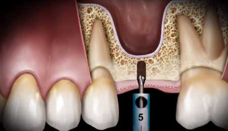 Sinus Augmentation