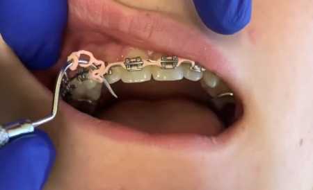 teeth overbite correction