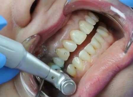Dental Treatment in Pregnancy