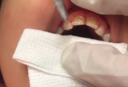 ow to Protect a Child's Teeth from Cavities