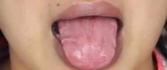Cracked Tongue