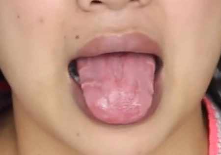 Cracked Tongue