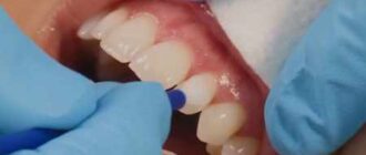 Restoration of tooth enamel