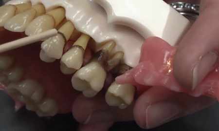 Periodontal Tissue Diseases