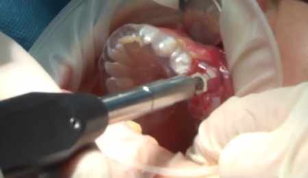 Dental Implant