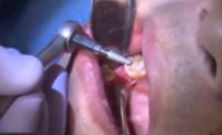 Implant Pain After Installation