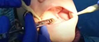 Tooth Extraction After Delivery
